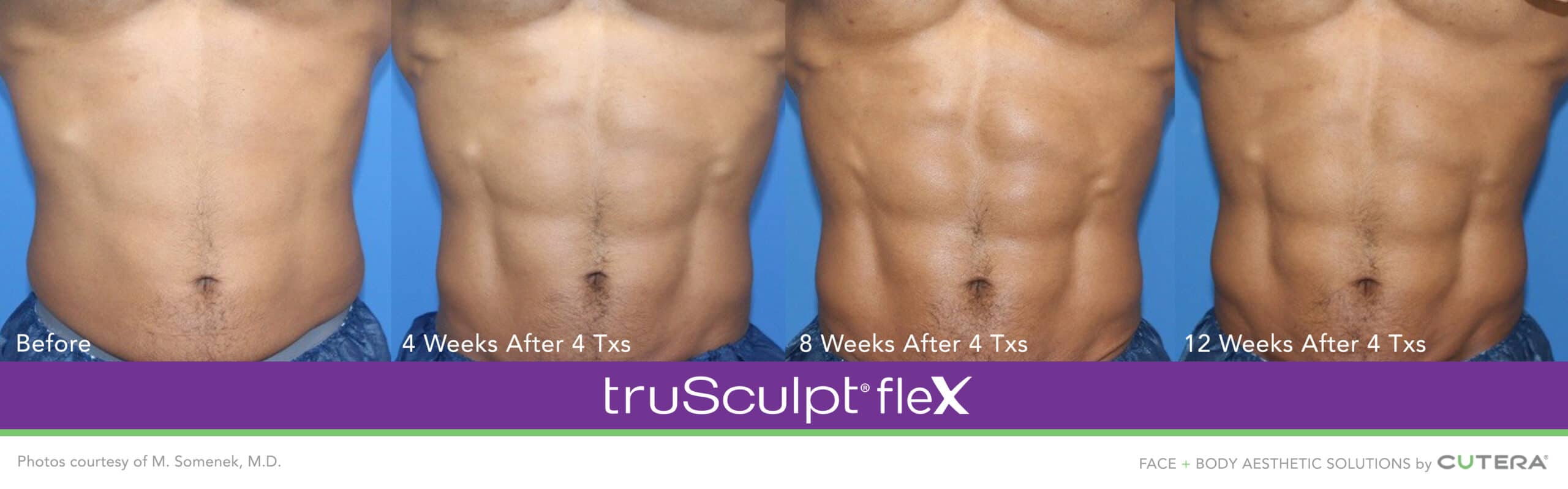 Muscle Toning – truSculpt flex - Plastic Surgery Montreal