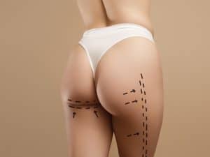 Liposuction in Montreal